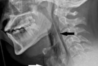 1763380107864-ngilu-tenggorokan-pria-ini-robek-disebut-gegara-sering-nahan-bersin_169