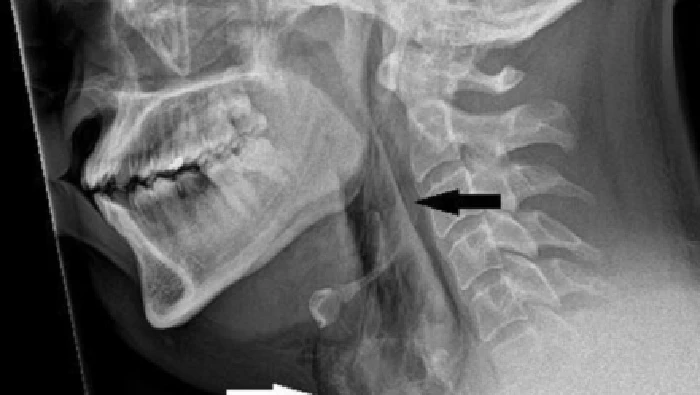 1763380107864-ngilu-tenggorokan-pria-ini-robek-disebut-gegara-sering-nahan-bersin_169