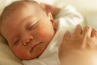 1767481483500-ilustrasi-ruam-pada-bayi_169